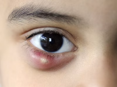চোখের সমস্যার হোমিওপ্যাথিক চিকিৎসা
